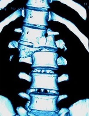 脊柱骨折的分型、诊断与治疗