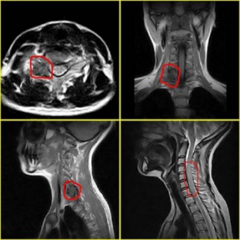 脊柱骨折的分型、诊断与治疗
