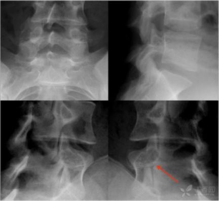 脊柱骨折的分型、诊断与治疗