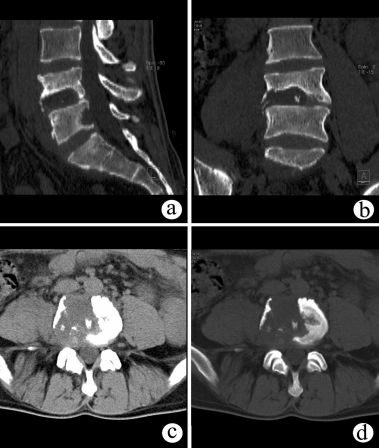 脊柱骨折的分型、诊断与治疗