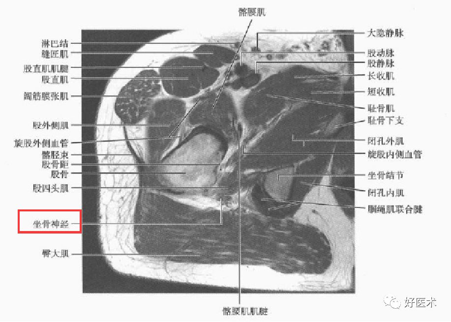 梨狀肌綜合征的解剖、評估、診斷，及康復治療 健康 第17張