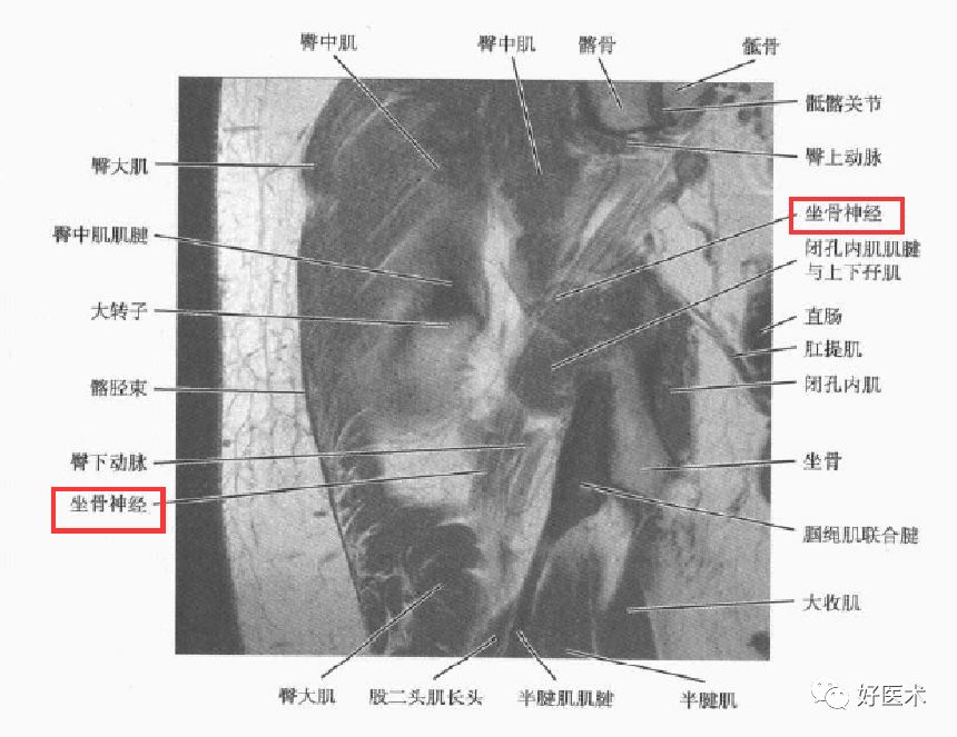 梨狀肌綜合征的解剖、評估、診斷，及康復治療 健康 第18張