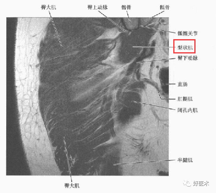 梨狀肌綜合征的解剖、評估、診斷，及康復治療 健康 第19張