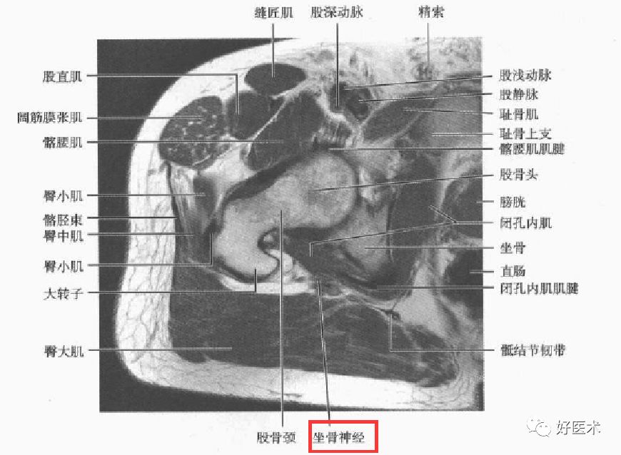 梨狀肌綜合征的解剖、評估、診斷，及康復治療 健康 第14張