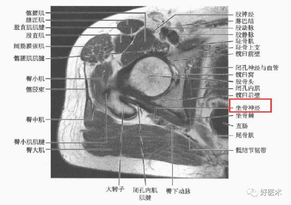 梨狀肌綜合征的解剖、評估、診斷，及康復治療 健康 第13張