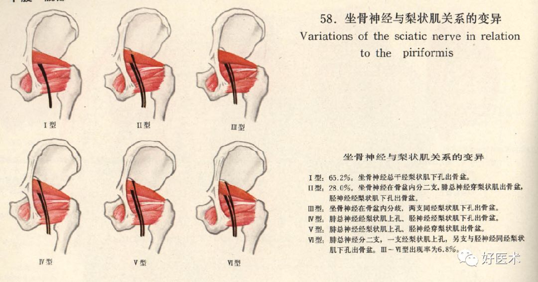 梨狀肌綜合征的解剖、評估、診斷，及康復治療 健康 第20張