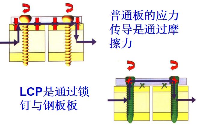 什么是锁定 骨科材料认识一下LCP锁定钢板-上海聚慕医疗器械有限公司