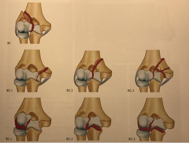 儿童肱骨远端骨折图解图片
