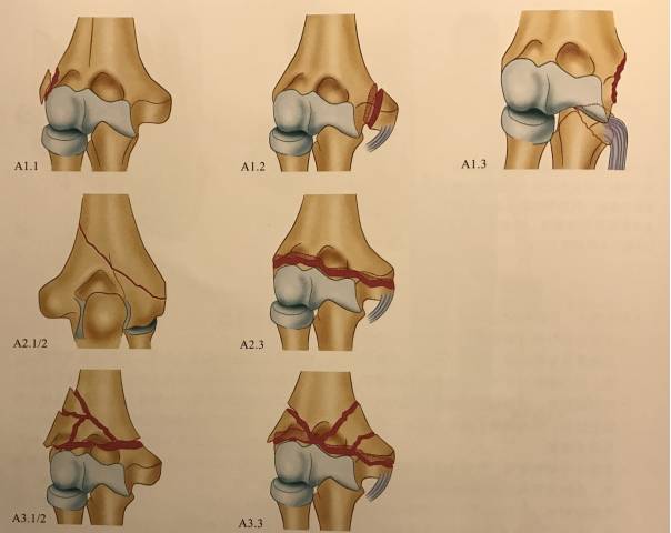 肱骨远端骨折的三种分型在这里!_医学界-助力医生临床决策和职业成长