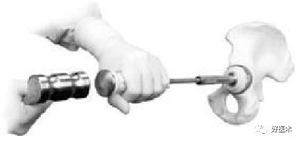 如何做好人工髋关节置换术？这篇全是干货！