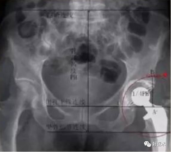 如何做好人工髋关节置换术？这篇全是干货！