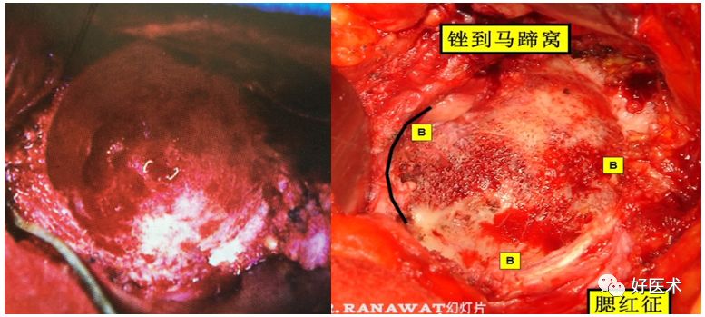 如何做好人工髋关节置换术？这篇全是干货！