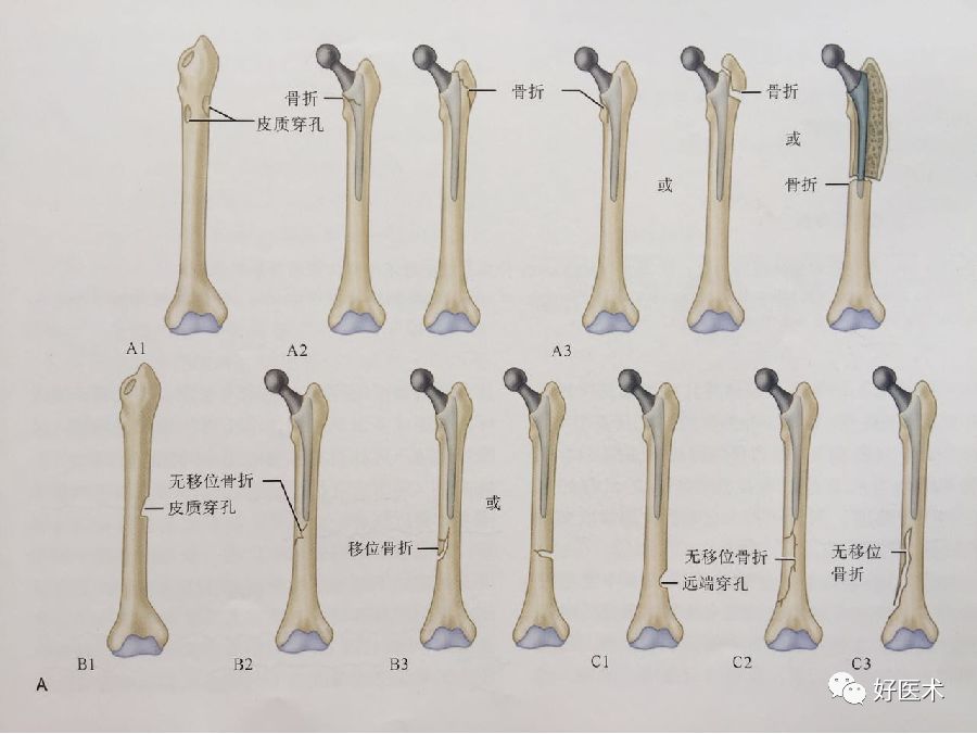 如何做好人工髋关节置换术？这篇全是干货！