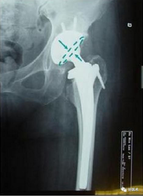 如何做好人工髋关节置换术？这篇全是干货！