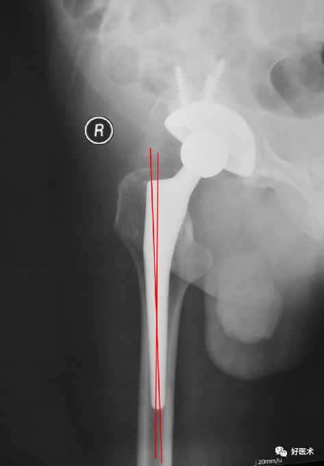 如何做好人工髋关节置换术？这篇全是干货！