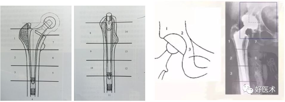如何做好人工髋关节置换术？这篇全是干货！
