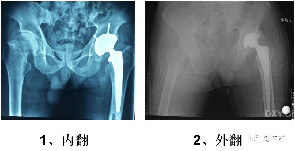如何做好人工髋关节置换术？这篇全是干货！