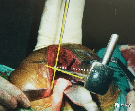 如何做好人工髋关节置换术？这篇全是干货！