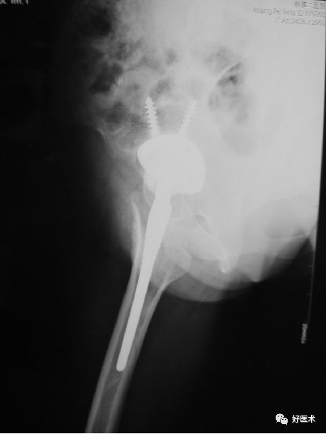 如何做好人工髋关节置换术？这篇全是干货！