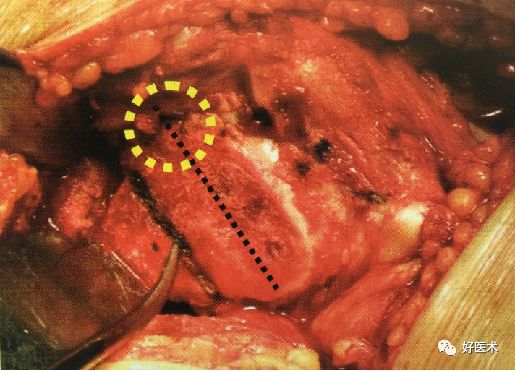 如何做好人工髋关节置换术？这篇全是干货！