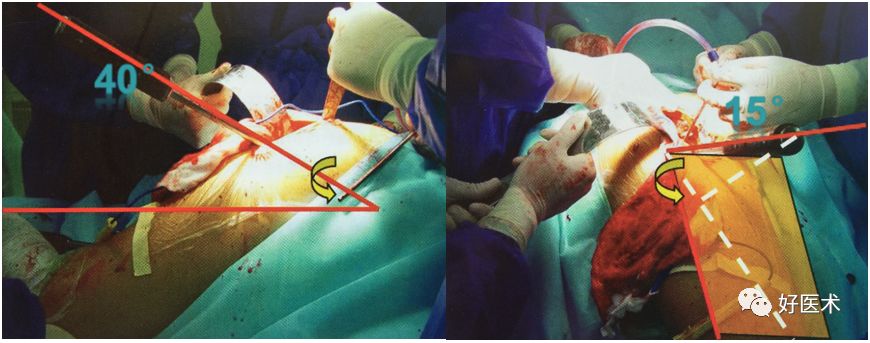 如何做好人工髋关节置换术？这篇全是干货！