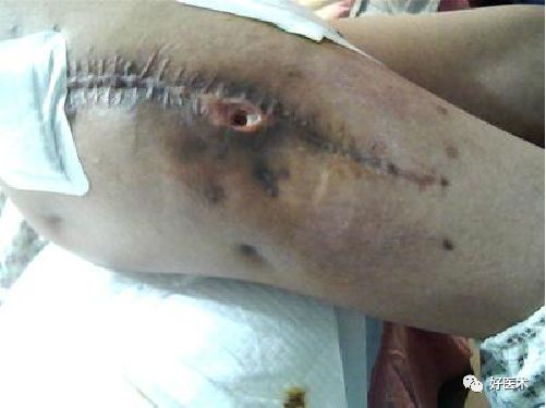 如何做好人工髋关节置换术？这篇全是干货！