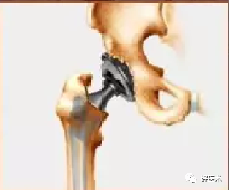 如何做好人工髋关节置换术？这篇全是干货！