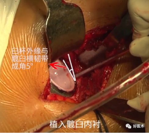 如何做好人工髋关节置换术？这篇全是干货！