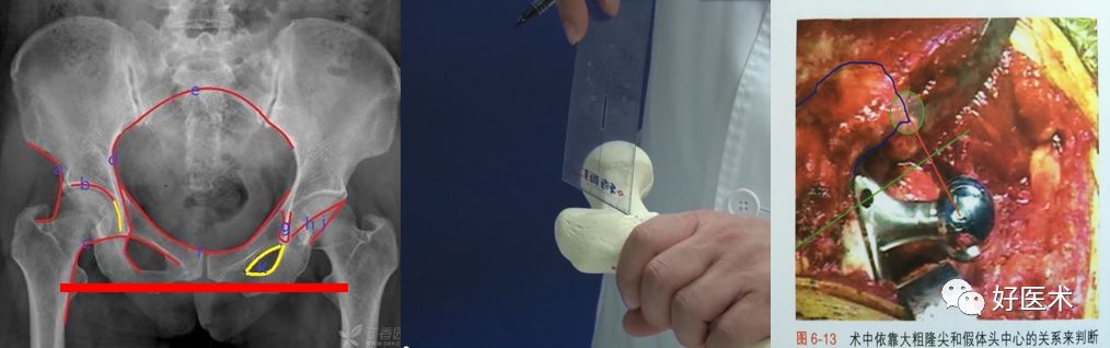 如何做好人工髋关节置换术？这篇全是干货！