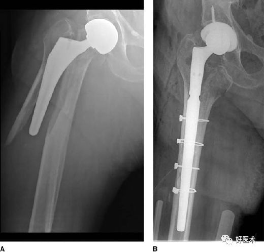 如何做好人工髋关节置换术？这篇全是干货！