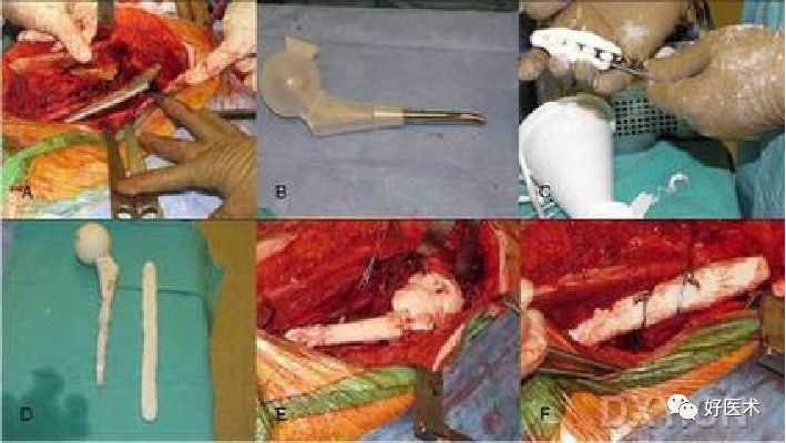 如何做好人工髋关节置换术？这篇全是干货！