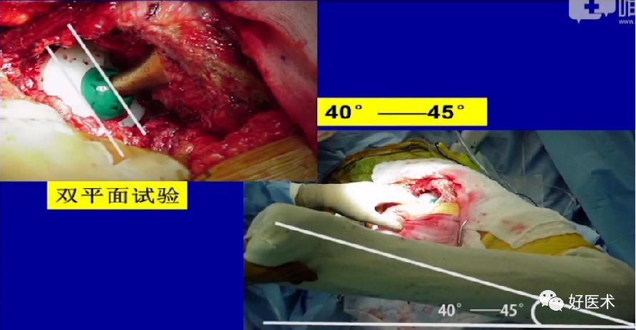 如何做好人工髋关节置换术？这篇全是干货！