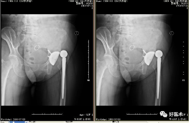 如何做好人工髋关节置换术？这篇全是干货！