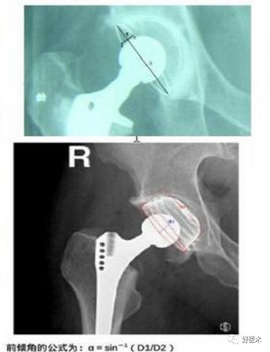 如何做好人工髋关节置换术？这篇全是干货！
