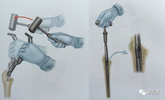 如何做好人工髋关节置换术？这篇全是干货！