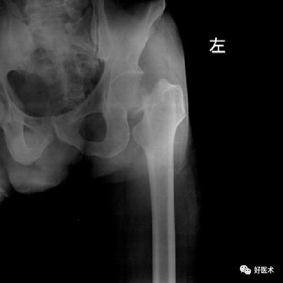 如何做好人工髋关节置换术？这篇全是干货！