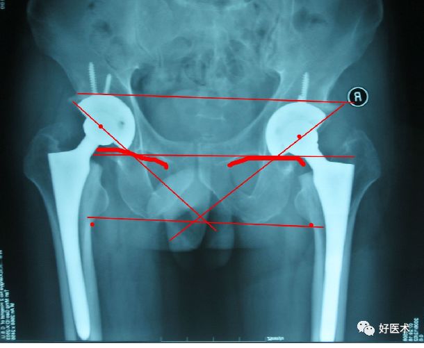 如何做好人工髋关节置换术？这篇全是干货！