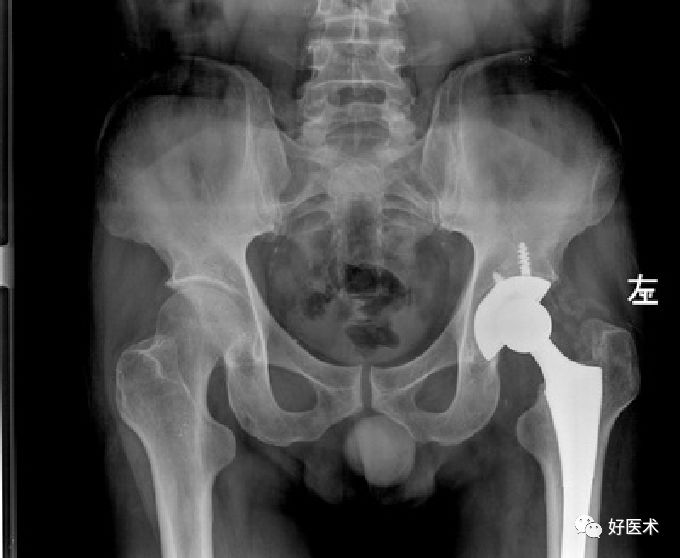 如何做好人工髋关节置换术？这篇全是干货！
