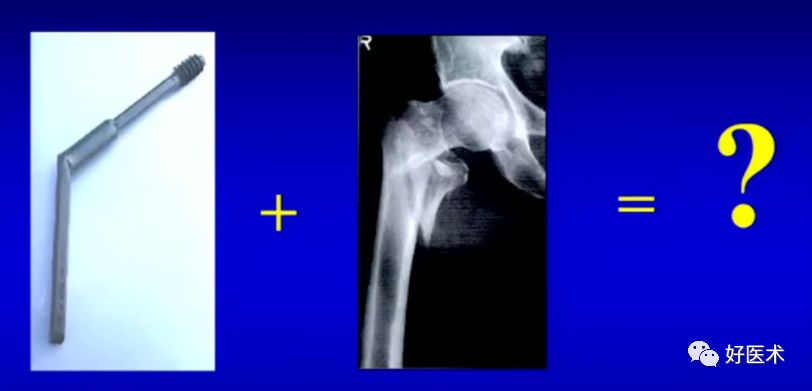 手把手教程：打牢转子间髓内钉，技巧在这！