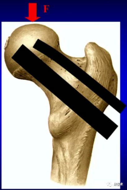 手把手教程：打牢转子间髓内钉，技巧在这！