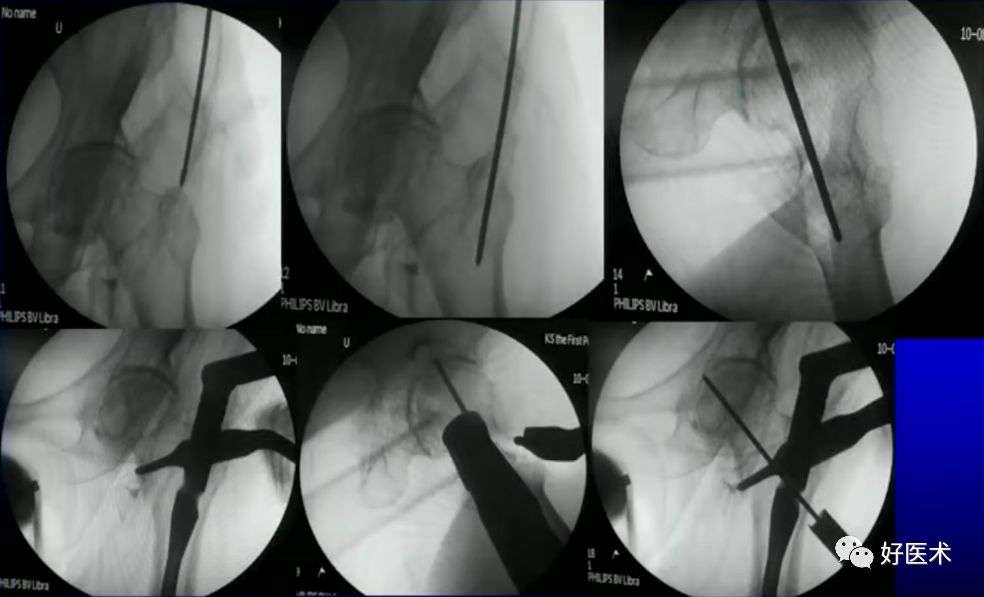手把手教程：打牢转子间髓内钉，技巧在这！