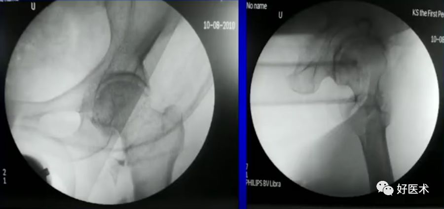 手把手教程：打牢转子间髓内钉，技巧在这！