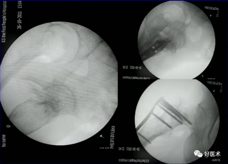 手把手教程：打牢转子间髓内钉，技巧在这！