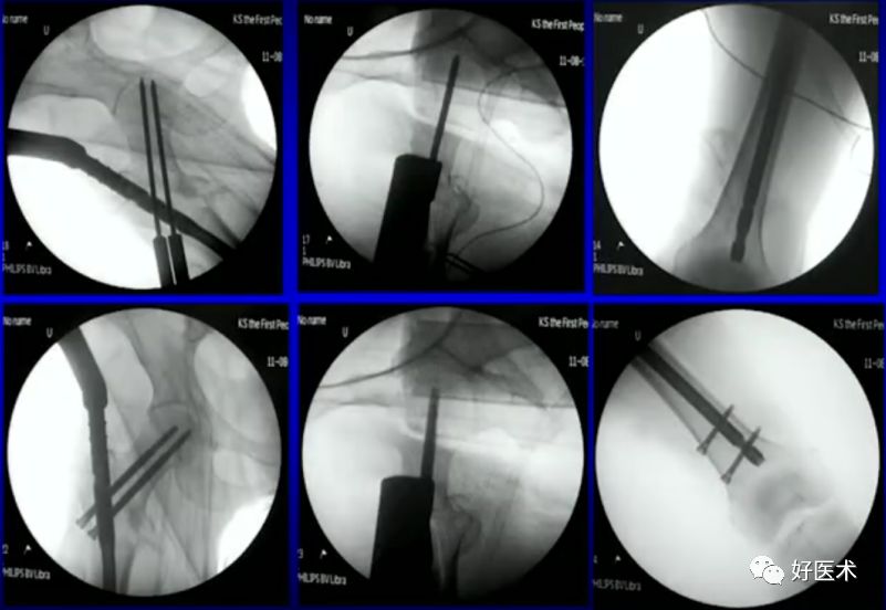手把手教程：打牢转子间髓内钉，技巧在这！