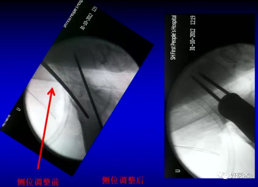 手把手教程：打牢转子间髓内钉，技巧在这！