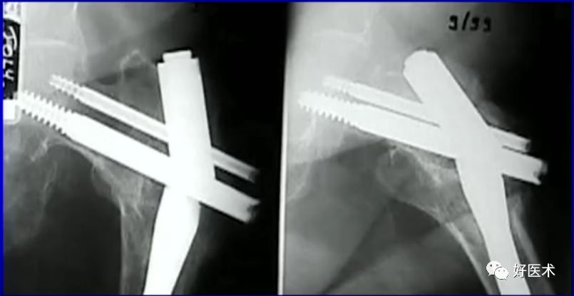 手把手教程：打牢转子间髓内钉，技巧在这！