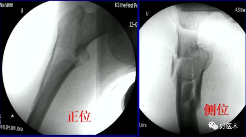 手把手教程：打牢转子间髓内钉，技巧在这！