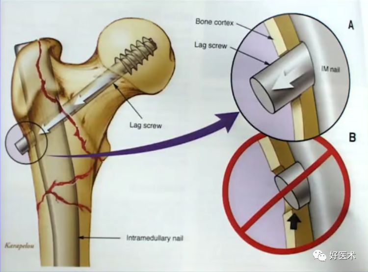 手把手教程：打牢转子间髓内钉，技巧在这！
