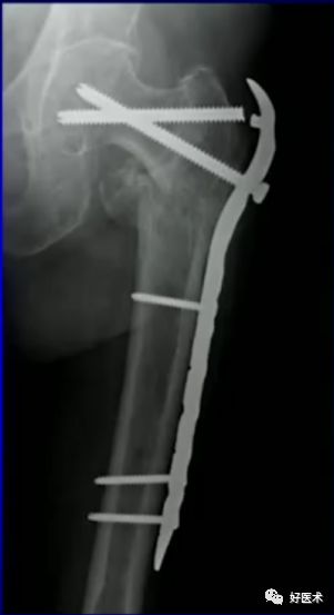 手把手教程：打牢转子间髓内钉，技巧在这！