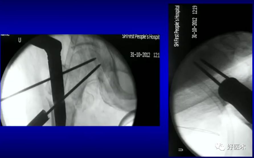 手把手教程：打牢转子间髓内钉，技巧在这！